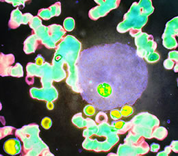 Recognizing Gaucher’s Disease in the Hematology Clinic