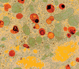 Newborn Screening for Lysosomal Diseases: Recent Progress and Unanswered Questions