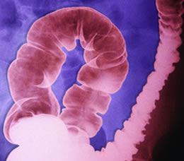 IBS-D Treatment: Incorporating Effective Strategies in a New Era