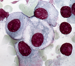 Improving Multiple Myeloma Care in a Rapidly Evolving Field