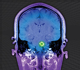 <i>Medical Insiders:</i> Changing the Treatment Paradigm to Improve Outcomes in MS