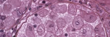 New Therapies in Gaucher’s Disease: Insights for Pharmacists New Therapies in Gaucher’s Disease: Insights for Pharmacists