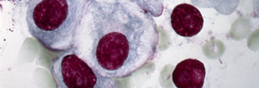 Improving Multiple Myeloma Care in a Rapidly Evolving Field Improving Multiple Myeloma Care in a Rapidly Evolving Field