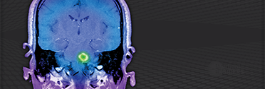 <i>Medical Insiders:</i> Changing the Treatment Paradigm to Improve Outcomes in MS <i>Medical Insiders:</i> Changing the Treatment Paradigm to Improve Outcomes in MS